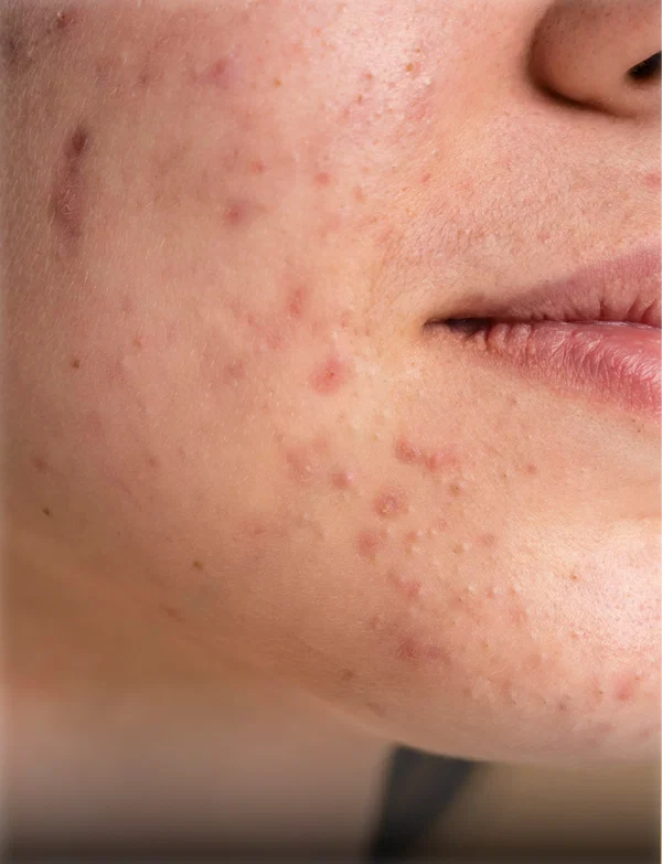 Acne